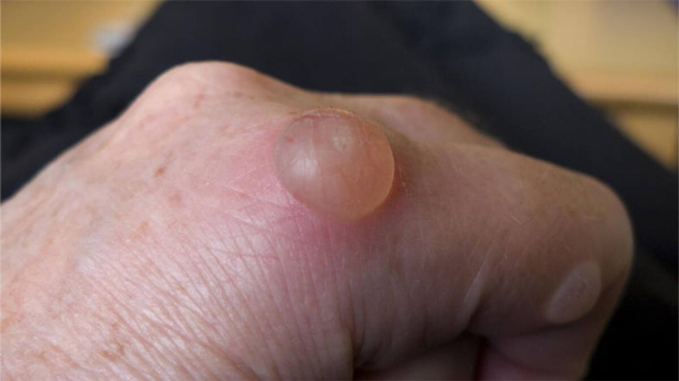 Why Shouldn’t We Pop Water-Filled Blisters?